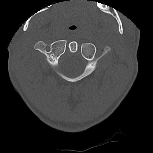 Apical pneumothorax on cervical spine CT (Radiopaedia 45343-49368 Axial bone window 15).jpg