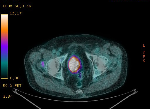 Appendiceal adenocarcinoma complicated by retroperitoneal abscess (Radiopaedia 58007-65041 Axial PET-CT 184).jpg