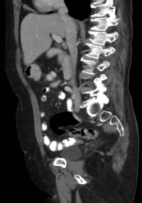 Appendicitis due to chicken fibula (Radiopaedia 74314-85198 C 41).jpg