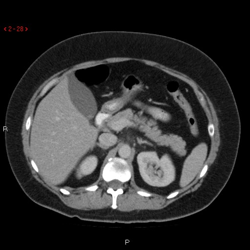 File:Appendicitis with microperforation- promontoric type (Radiopaedia 27268-27442 C 16).jpg