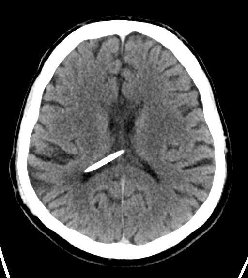 File:Aqueduct stenosis with corpus callosum hypoattenuation post shunting (Radiopaedia 37212-38971 Axial non-contrast 17).png