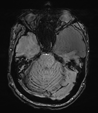 Arachnoid cyst with subdural hematoma (Radiopaedia 85892-101743 Axial SWI 26).png