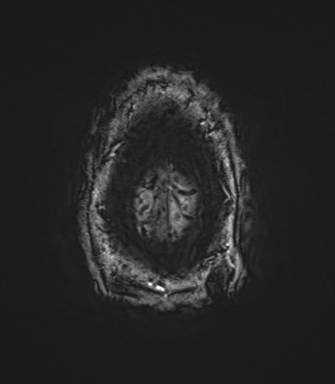 Arachnoid cyst with subdural hematoma (Radiopaedia 85892-101743 Axial SWI 86).png