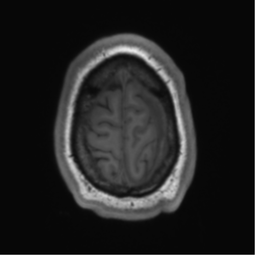 File:Arachnoid cyst with subdural hematoma (Radiopaedia 85892-101743 Axial T1 76).png