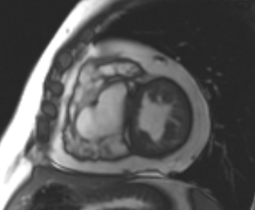Arrhythmogenic right ventricular cardiomyopathy (Radiopaedia 69431-79307 Short axis cine 112).jpg