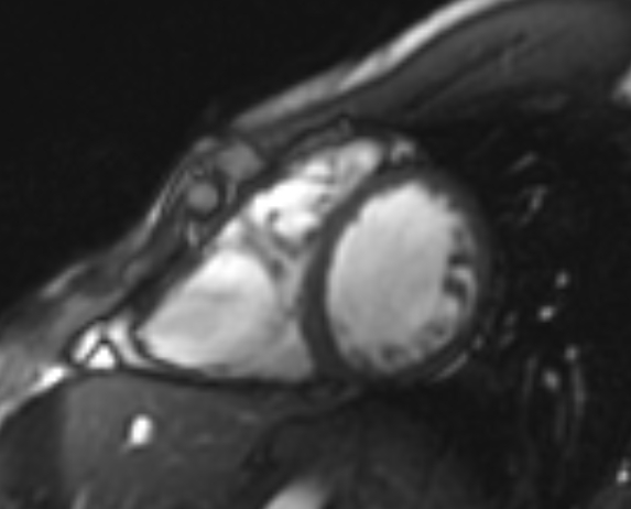 Arrhythmogenic right ventricular cardiomyopathy (Radiopaedia 69564-79464 short axis cine 119).jpg