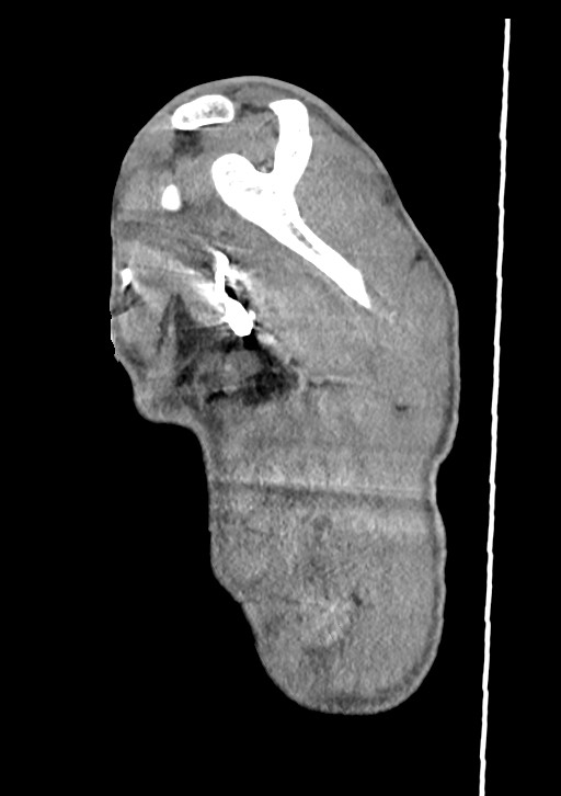 Arrow injury in the neck (Radiopaedia 75268-86390 G 21).jpg
