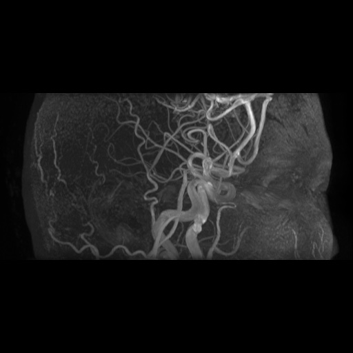 Arteriovenous malformation (Radiopaedia 71628-81999 Axial MRA 18).jpg
