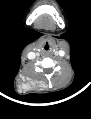Arteriovenous malformation of the neck (Radiopaedia 53935-60062 B 28).jpg