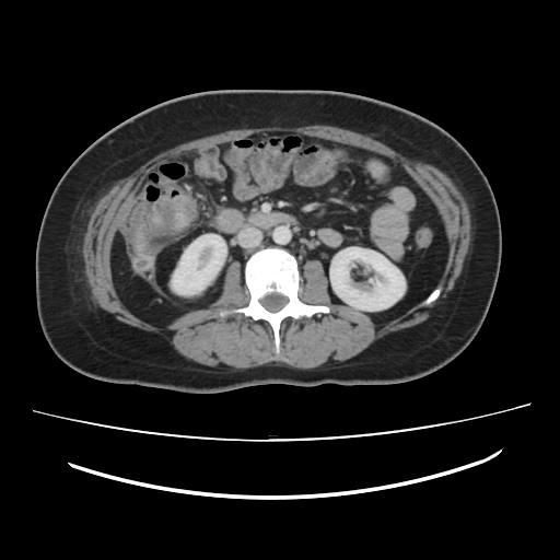 Ascending retrocecal appendicitis with liver abscesses (Radiopaedia 60066-67615 B 45).jpg