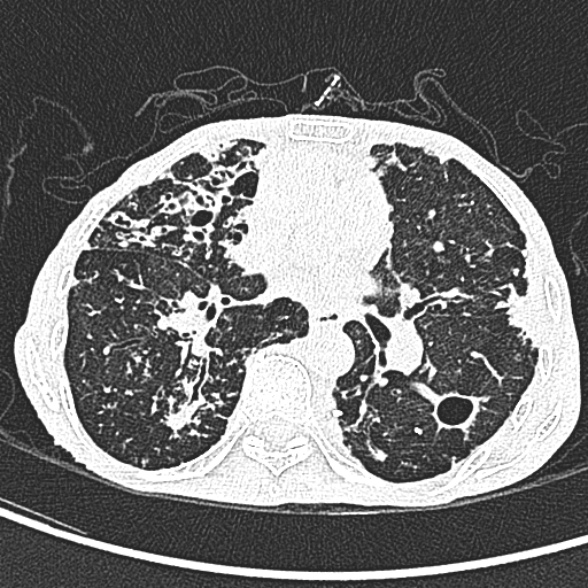 File:Aspergilloma- with Monod sign (Radiopaedia 44737-48532 Axial lung window 138).jpg