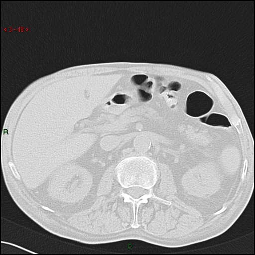File:Aspergilloma (Radiopaedia 14842-14787 Axial lung window 48).jpg