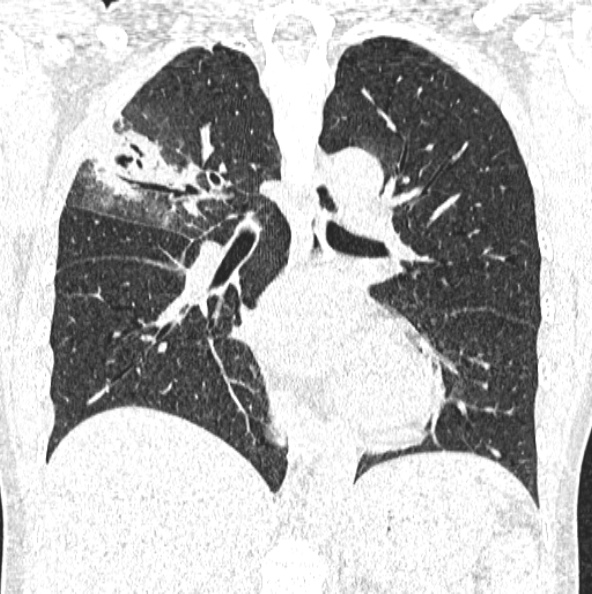 File:Aspergilloma (Radiopaedia 26223-26347 Coronal lung window 30).jpg