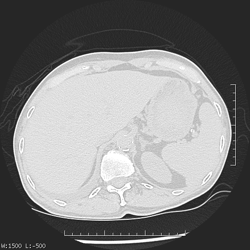 Aspergilloma (Radiopaedia 75184-86270 Axial lung window 54).jpg