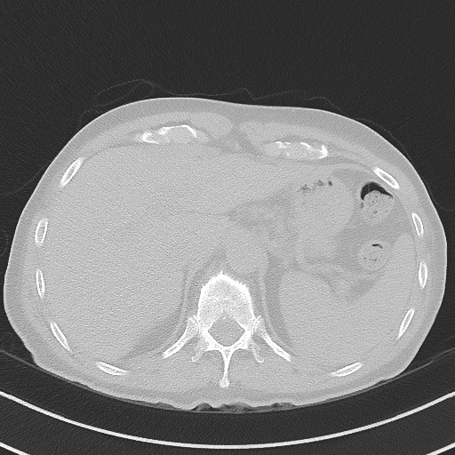 Aspergilloma on background pulmonary fibrosis (Radiopaedia 60942-68757 A 53).jpg