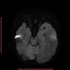 Astroblastoma (Radiopaedia 74287-85162 Axial DWI 35).jpg