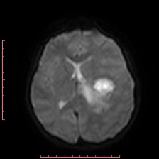 File:Astroblastoma (Radiopaedia 74287-85162 Axial DWI 56).jpg