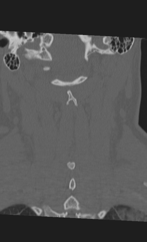 Atlanto-occipital dissociation (Radiopaedia 33848-35013 Coronal bone window 40).png