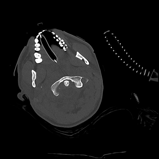 File:Atlanto-occipital dissociation (Traynelis type 1), C2 teardrop fracture, C6-7 facet joint dislocation (Radiopaedia 87655-104061 Axial bone window 19).jpg