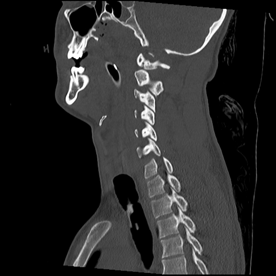Atlanto-occipital dissociation (Traynelis type 1), C2 teardrop fracture, C6-7 facet joint dislocation (Radiopaedia 87655-104061 Sagittal bone window 31).jpg