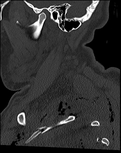 Atlanto-occipital dissociation - Traynelis type 1 (Radiopaedia 87570-103948 Sagittal bone window 20).jpg