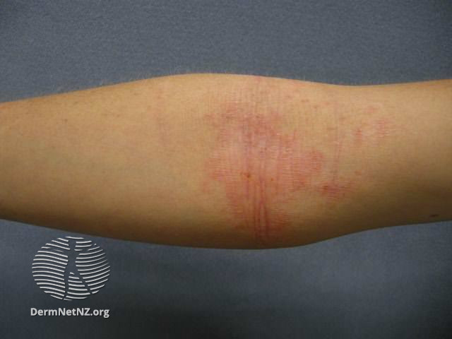 File:Atopic dermatitis (DermNet NZ dermatitis-flexural-eczema14).jpg
