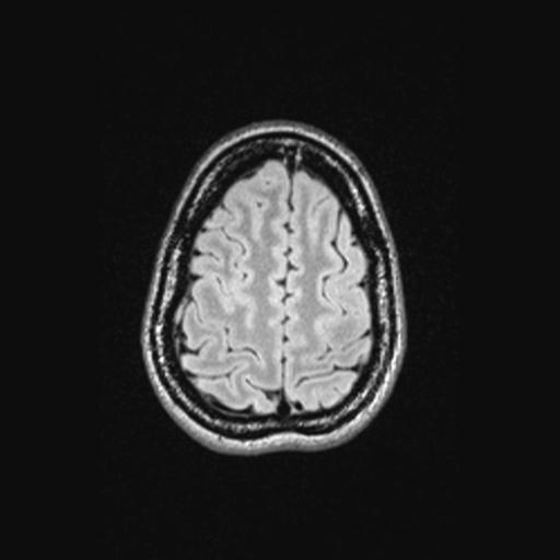 Atretic encephalocoele with inferior vermis hypoplasia (Radiopaedia 30443-31108 Axial 131).jpg
