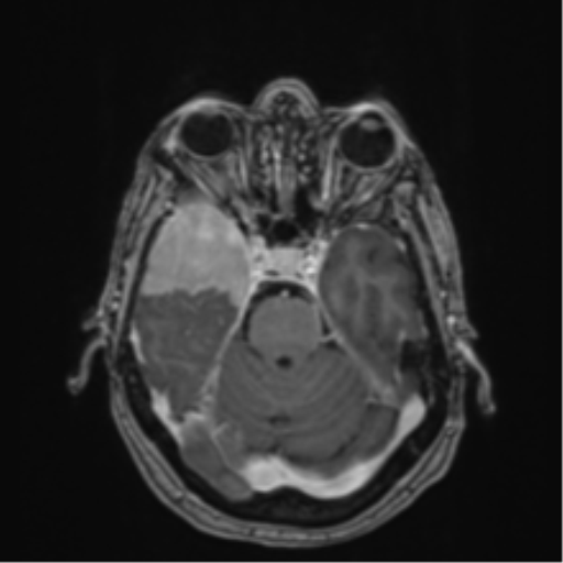 Atypical meningioma (WHO Grade II) (Radiopaedia 54742-60979 Axial T1 C+ 19).png