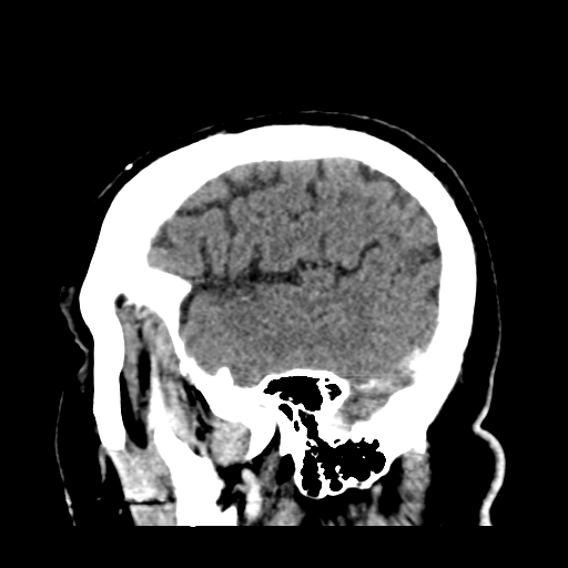 Atypical meningioma (WHO grade II) with brain invasion (Radiopaedia 57767-64728 Sagittal C+ 43).png