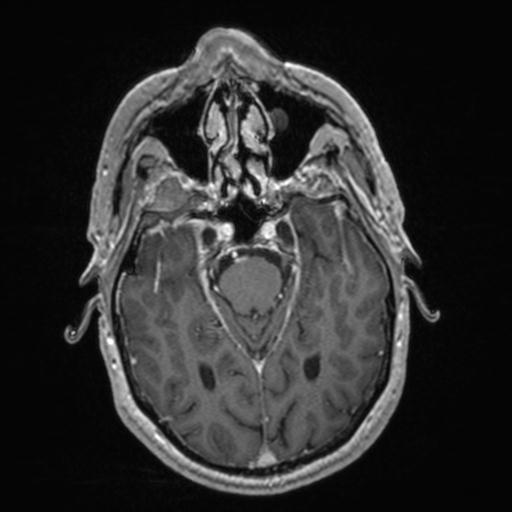 Atypical meningioma (grade II) - en plaque (Radiopaedia 29633-30147 Axial T1 C+ 68).jpg
