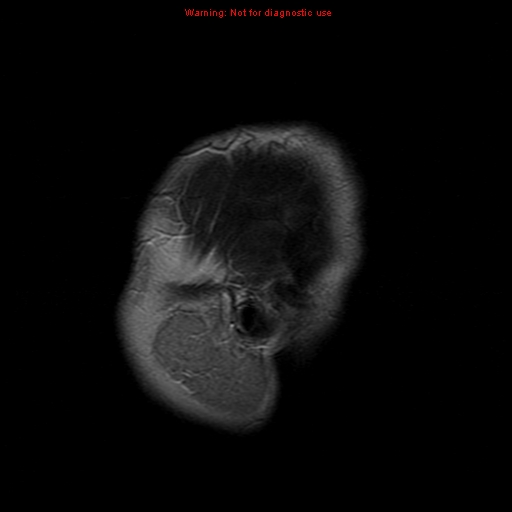 File:Atypical meningioma - grade II (Radiopaedia 13303-13305 Sagittal T2 1).jpg