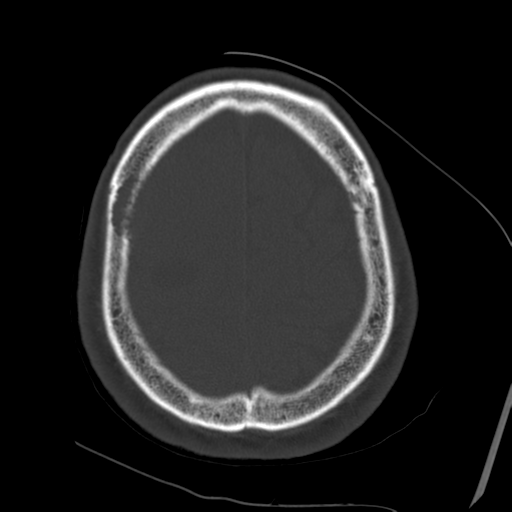 Atypical meningioma with skull invasion (Radiopaedia 34357-35649 Axial bone window 67).png