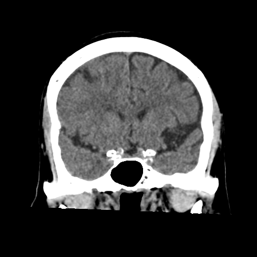 Atypical meningioma with skull invasion (Radiopaedia 34357-35649 Coronal non-contrast 26).png