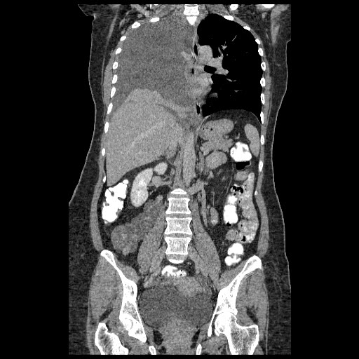 File:Atypical retroperitoneal lymphocoeles with large leiomyoma of uterus (Radiopaedia 32084-33024 B 13).jpg