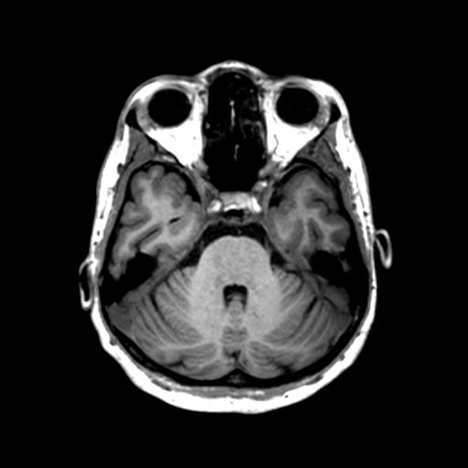 Autoimmune limbic encephalitis (Radiopaedia 30363-31005 T1 Axial 1mm 49).jpg