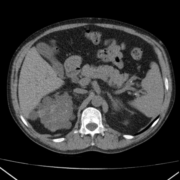 File:Autosomal dominant polycystic kidney disease (Radiopaedia 36539-38101 Axial non-contrast 26).jpg