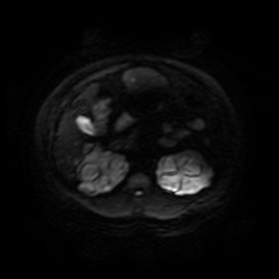 Autosomal dominant polycystic kidney disease (Radiopaedia 50259-55611 Axial DWI 55).jpg