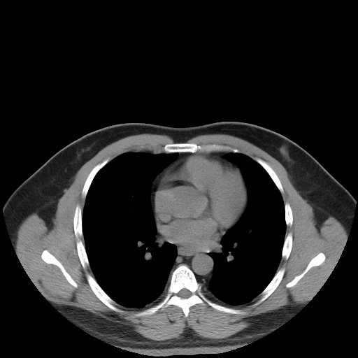 File:Autosomal dominant polycystic kidney disease (Radiopaedia 50259-55612 Axial non-contrast 3).jpg