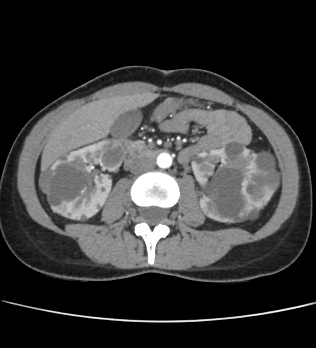 Autosomal dominant polycystic kidney disease - early onset (Radiopaedia 40734-43387 B 33).jpg