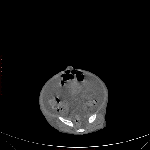 Autosomal recessive polycystic kidney disease associated with Caroli disease (Radiopaedia 61932-69984 Axial non-contrast 305).jpg