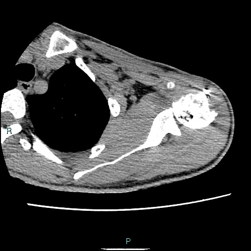 Avascular necrosis after fracture dislocations of the proximal humerus (Radiopaedia 88078-104653 D 33).jpg