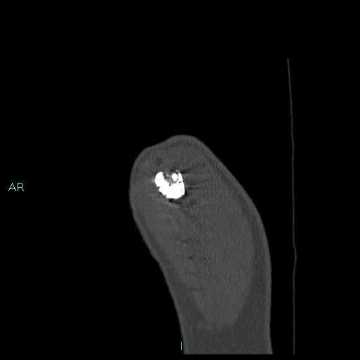 Avascular necrosis after fracture dislocations of the proximal humerus (Radiopaedia 88078-104655 Sagittal bone window 6).jpg