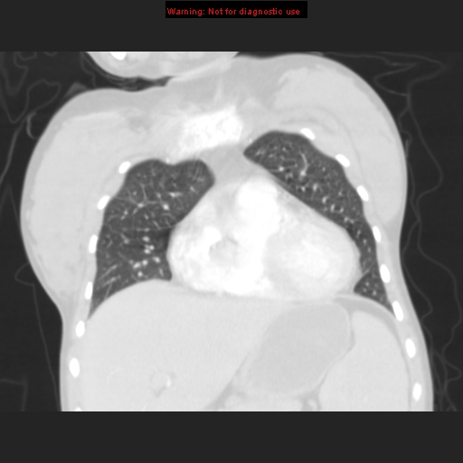 File:Avascular necrosis in sickle cell disease (Radiopaedia 17448-17152 B 36).jpg