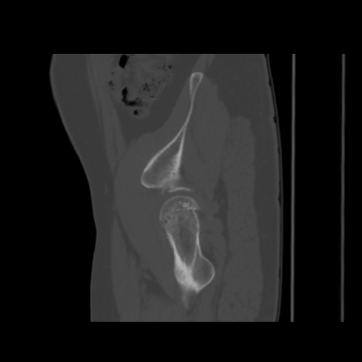 Avascular necrosis of the hip (Radiopaedia 61503-69467 B 11).jpg