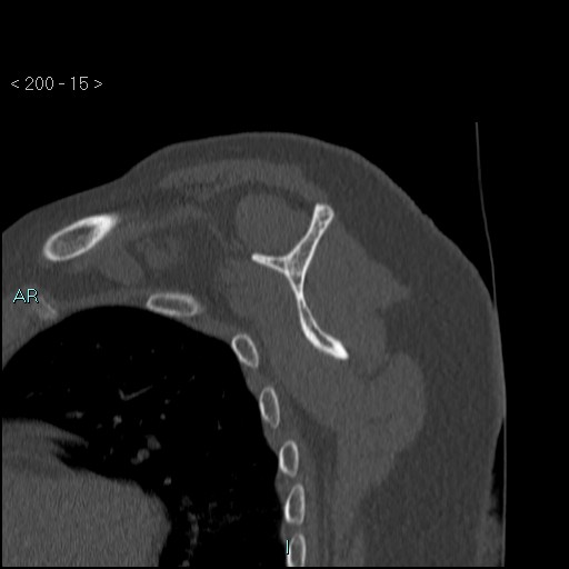 File:Avascular necrosis of the shoulder - Cruess stage I (Radiopaedia 77674-89887 Sagittal bone window 14).jpg