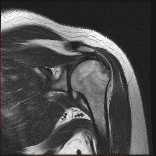 File:Avulsion fracture - greater tuberosity of humerus (Radiopaedia 25457-25703 Coronal T2 8).jpg
