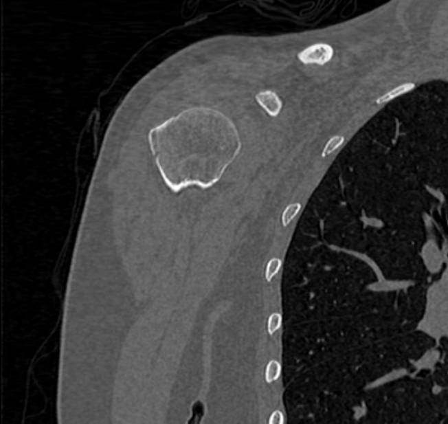 Avulsion fracture - greater tuberosity of humerus (Radiopaedia 71216-81514 Coronal bone window 13).jpg