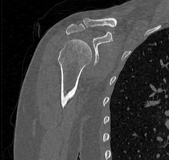 Avulsion fracture - greater tuberosity of humerus (Radiopaedia 71216-81514 Coronal bone window 25).jpg