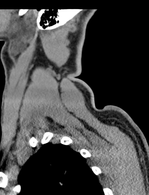 Axis peg fracture (type 3) and atlas lateral mass (type 4) fracture (Radiopaedia 37474-39324 D 72).png