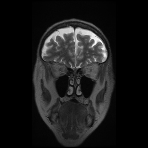 Balo concentric sclerosis (Radiopaedia 53875-59982 Coronal T2 35).jpg